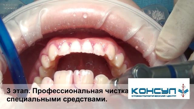Профессиональная гигиена полости рта. Все этапы. смотреть онлайн