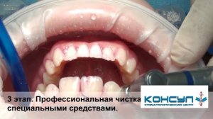 Профессиональная гигиена полости рта. Все этапы.