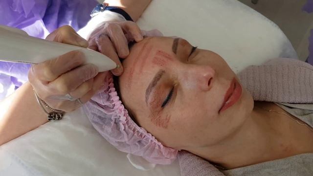 Как делать процедуру плазменного омоложения, курсы в Татуэль смотреть онлайн