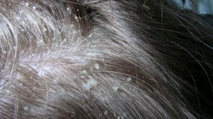 Как избавиться от перхоти в домашних условиях?