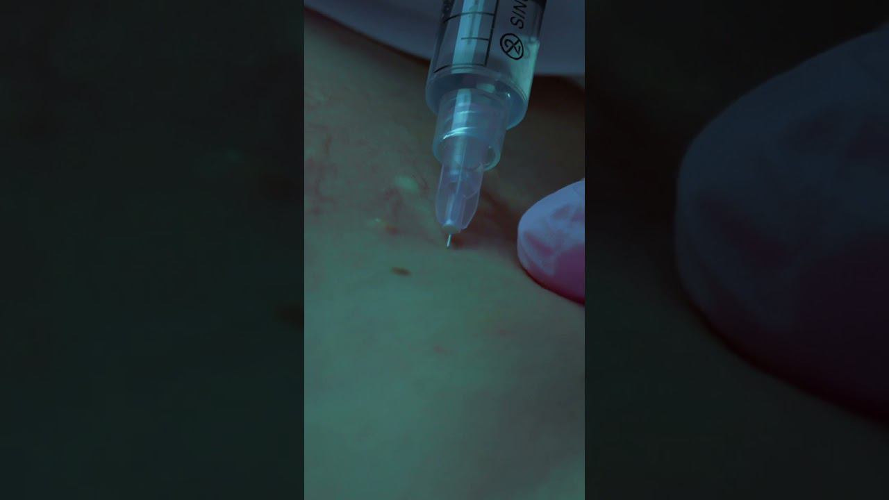 Мезотерапия: сияющая кожа зоны декольте смотреть онлайн