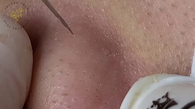 Acne Treament Under The Skin #068 смотреть онлайн