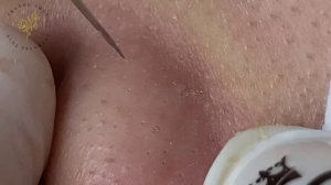 Acne Treament Under The Skin #068