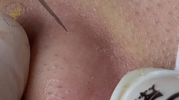 Acne Treament Under The Skin #068