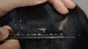 Зудящая сухая кожа головы Большие царапины от перхоти #881