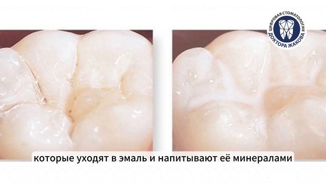 Герметизация фиссур смотреть онлайн