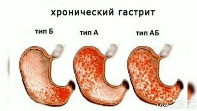 Гастрит и различные виды Мамедова М 025 смотреть онлайн