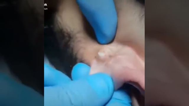 Removal Of A Build-up Near The Auricle,Удаление нароста в возле ушной раковины