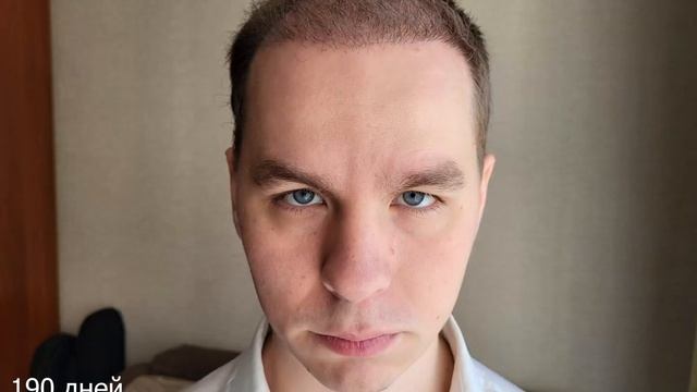 (НЕ)удачная пересадка волос. Или..? смотреть онлайн