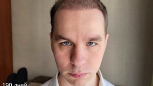 (НЕ)удачная пересадка волос. Или..?