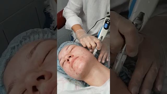 Фракционная мезотерапия лица. смотреть онлайн