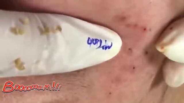 ПРЫЩИ и угри ВЫДАВЛИВАНИЕ новое