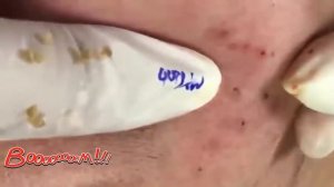 ПРЫЩИ и угри ВЫДАВЛИВАНИЕ новое