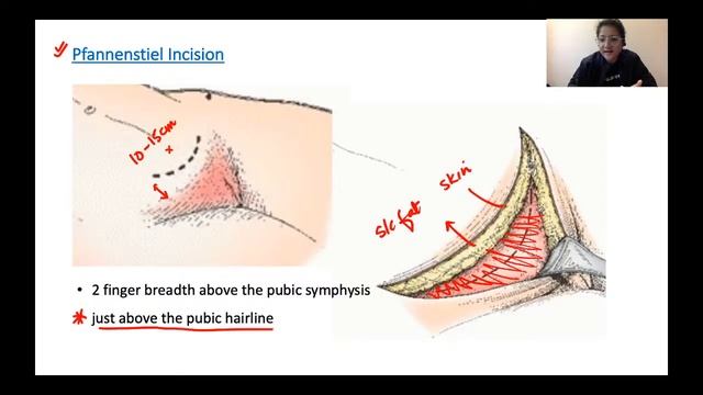 Lower Segment Cesarean Section | Relevant Anatomy & Procedure | NEET PG 2021 | Dr. Shonali Chandra смотреть онлайн