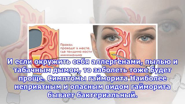 Гайморит: что делать, чтобы насморк не стал кошмаром смотреть онлайн