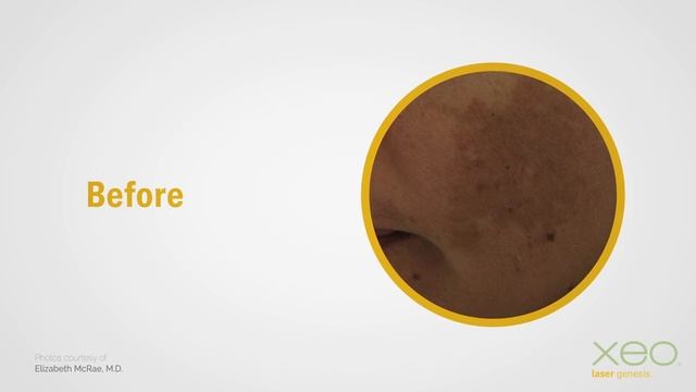 Cutera xeo® - Laser Genesys to Reduce Fineline Sun Damage смотреть онлайн