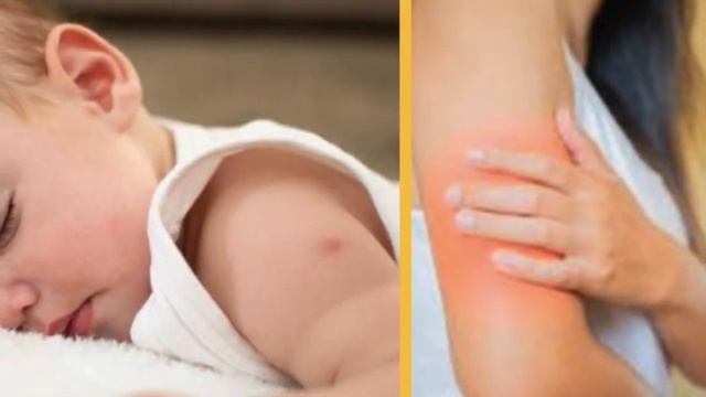 Can we apply ice after taking injection? смотреть онлайн