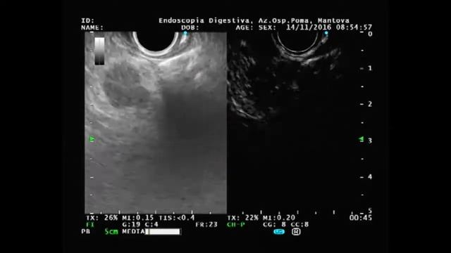 Stomach lymph node metastasis from rectal cancer смотреть онлайн