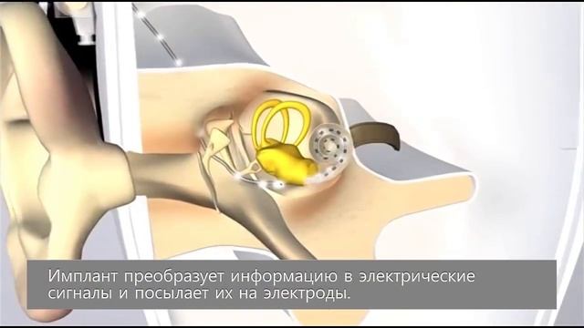 Как работает кохлеарный имплант смотреть онлайн