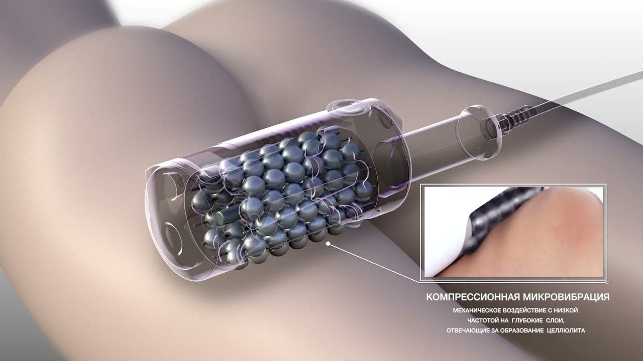 Endospheres Therapy (Эндосфера терапия) – инновационный метод похудения! смотреть онлайн