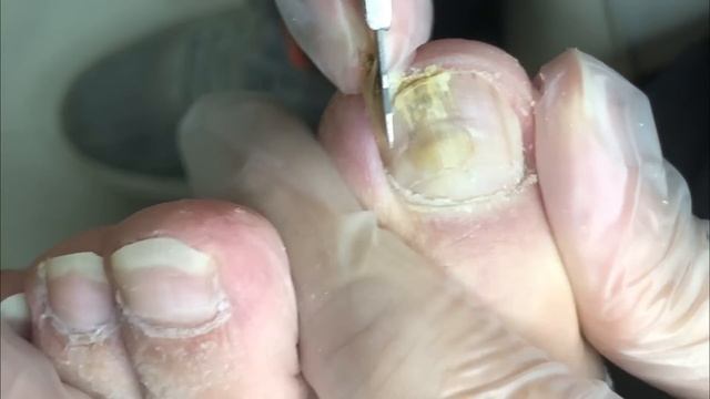 Nail fungus treatment, professional pedicure process【DrZhang】 смотреть онлайн