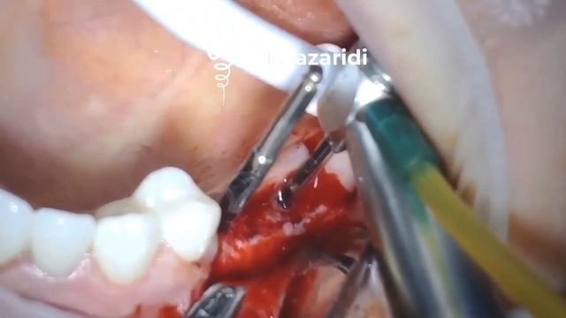 ОТКРЫТЫЙ СИНУС-ЛИФТИНГ + ИМПЛАНТАЦИЯ \ SINUS LIFT + DENTAL IMPLANTS смотреть онлайн