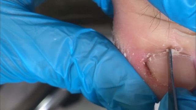 Ingrown armor penetrates too deep and cannot be pulled off смотреть онлайн