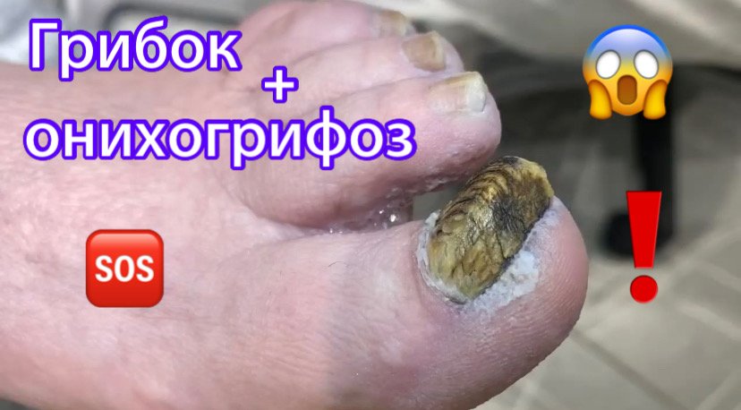 Грибок ? + Онихогрифоз ❗️⚠️? смотреть онлайн