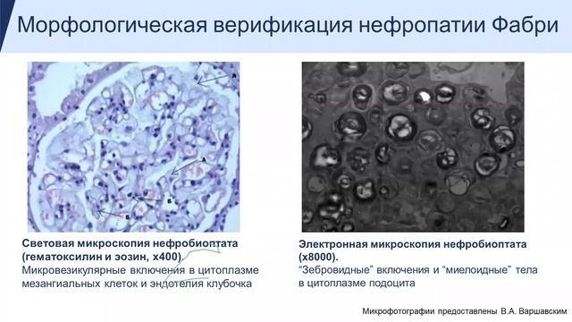 Болезнь ФабриБолезнь Фабри - действительно ли большая редкость?
