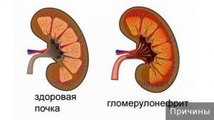 Гломерулонефрит. Как лечить гломерулонефрит.