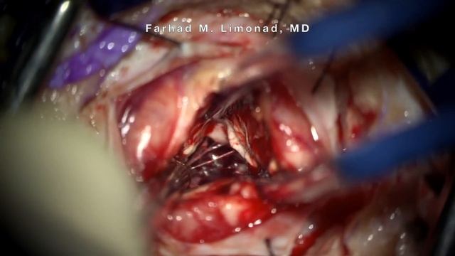 Brain hemorrhage: Surgical management of spontaneous brain hemorrhage resulting in coma смотреть онлайн