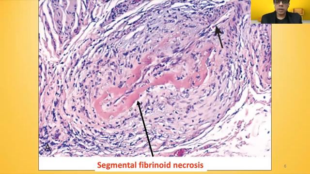 Polyarteritis Nodosa|What Are The Signs And Symptoms Of Polyarteritis Nodosa? Usmle,neetpg,plab,fmg