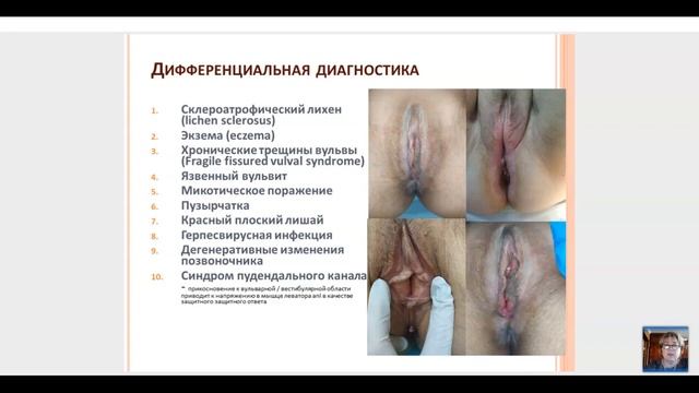 Вебинар Вульводиния как междисциплинарная проблема смотреть онлайн