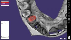 Моделирование культевой вкладки - Exocad