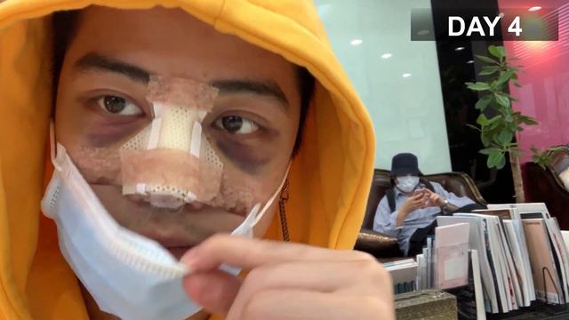 My Nose Surgery (using rib bone) and the Recovery Process смотреть онлайн