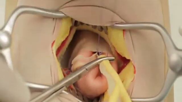 Обучающее видео. Моделирование аппендэктомии на муляжже смотреть онлайн