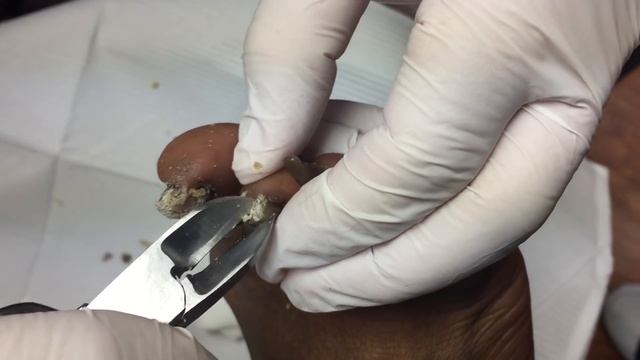Thickest Toe Nails Ever!! Fungal Toenails. Nail Fungus! смотреть онлайн