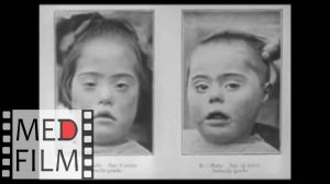 Schizophrenia in children - how to identify © Шизофрения у детей - диагностика