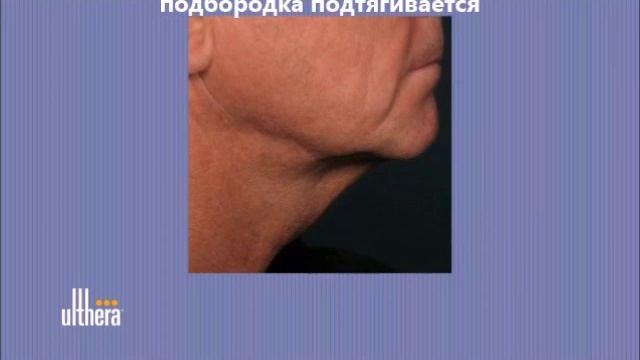 Leaders Clinic Ulthera Клиника Лидерс Ульсера смотреть онлайн