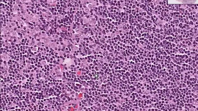 Histopathology Lymph node-- Metastatic breast carcinoma смотреть онлайн
