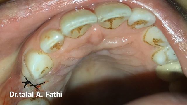 Dental implant tooth no. 14 смотреть онлайн