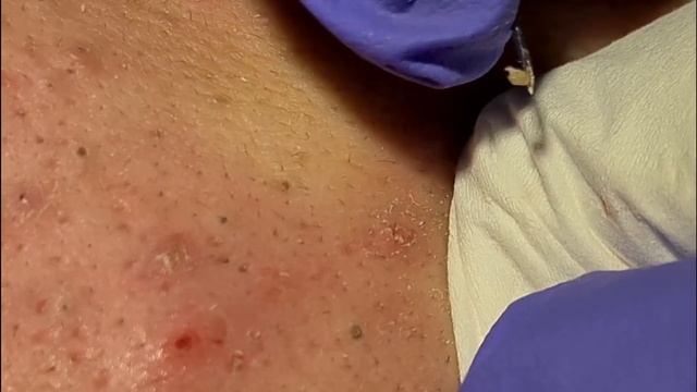 BLACKHEADS EXTRACTIONS On Happy #15