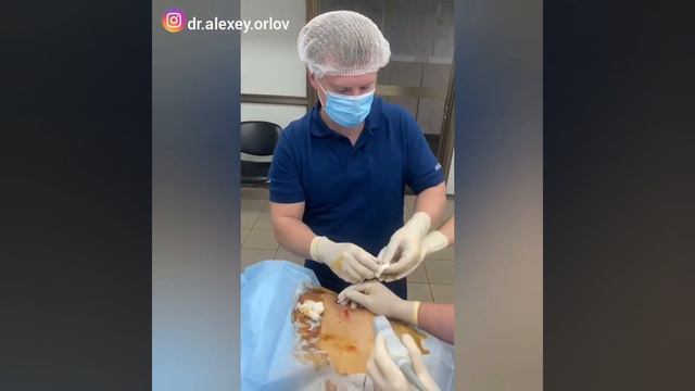 💉Пункция жидкостных коллекторов при остром панкреатите смотреть онлайн