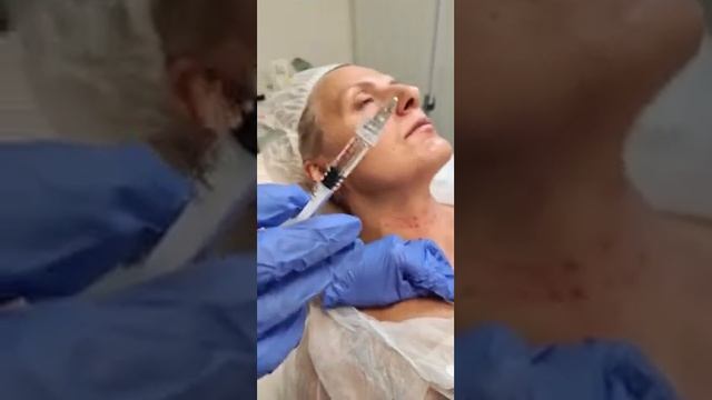 Мезонити Darvin, филлеры ADVANCE. Омоложение шеи и декольте. Что выбрать: нити или филлер? смотреть онлайн