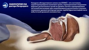 Что такое апноэ сна? Синдром обструктивного апноэ во сне (СОАС)