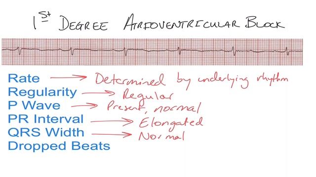 1st Degree AV Block ECG - EMTprep.com смотреть онлайн