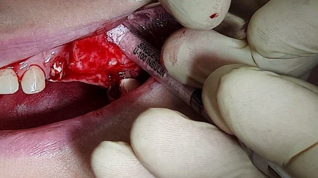Открытый синуслифтинг в обл. 26. Н от 9.10.20г. lateral sinus lift смотреть онлайн