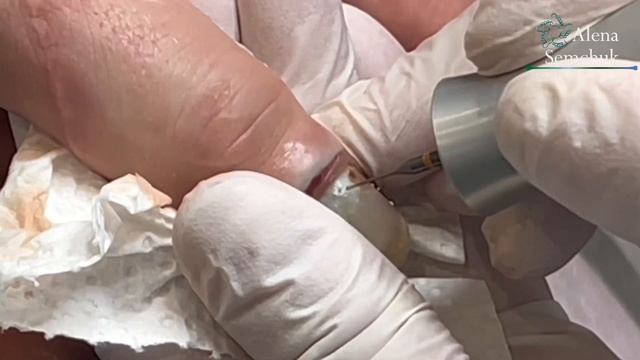 Подногтевая гранулема subungual granuloma смотреть онлайн