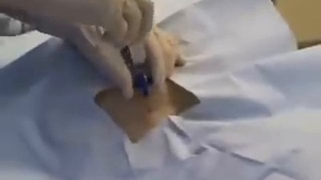 Биопсия костного мозга (Video-med.ru) смотреть онлайн