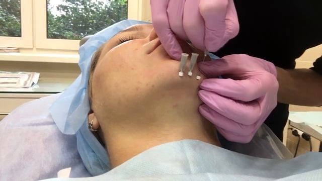 Установка мезонину в субментальную зону смотреть онлайн